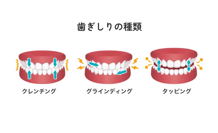 診療案内-歯ぎしり・食いしばり治療-歯ぎしりの種類